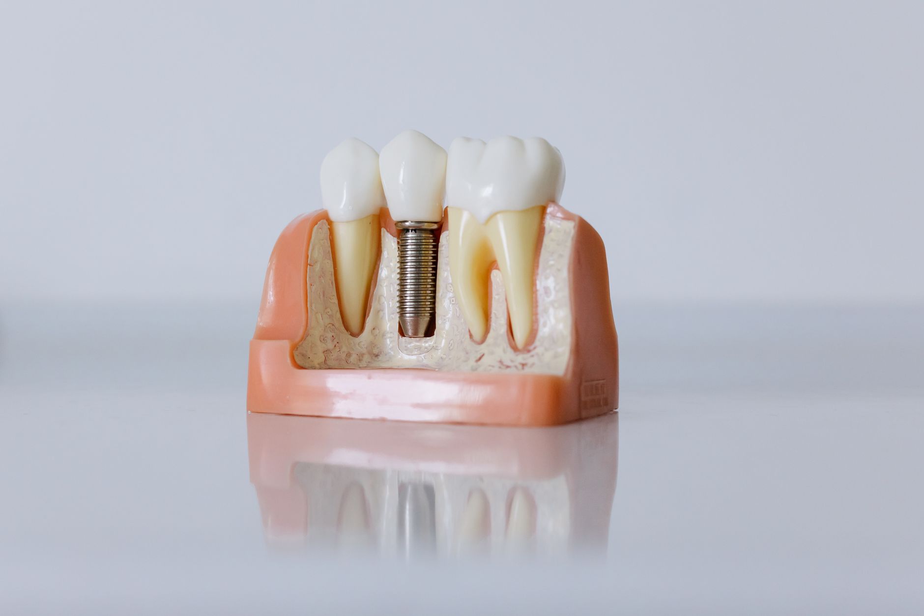 Implanturile dentare devin din ce în ce mai populare datorită beneficiilor pe termen lung și a rezultatelor estetice superioare